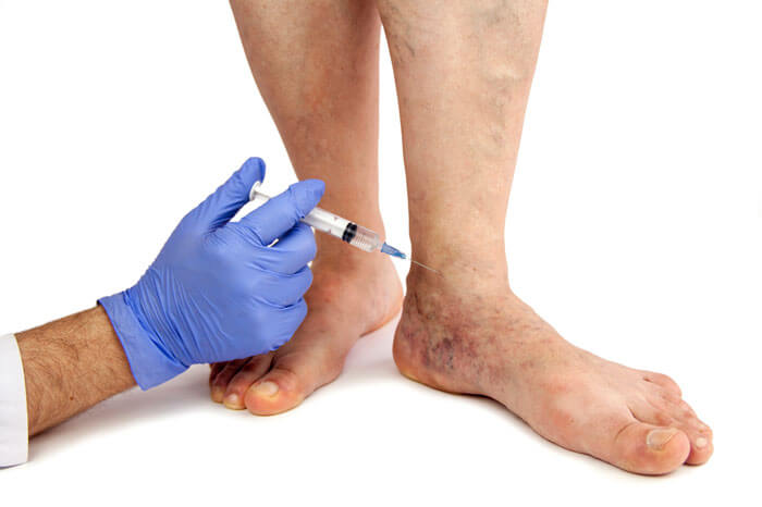 Comparing Treatment Options for Varicose Veins: What’s Right for You?